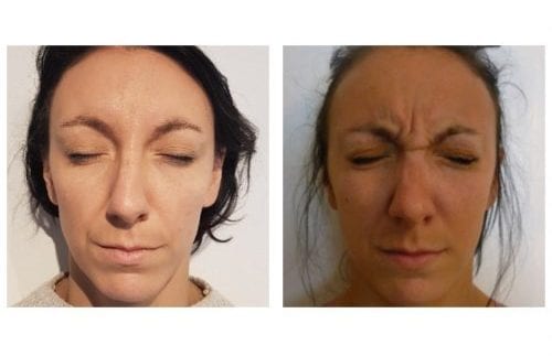 Botox injection for frown lines