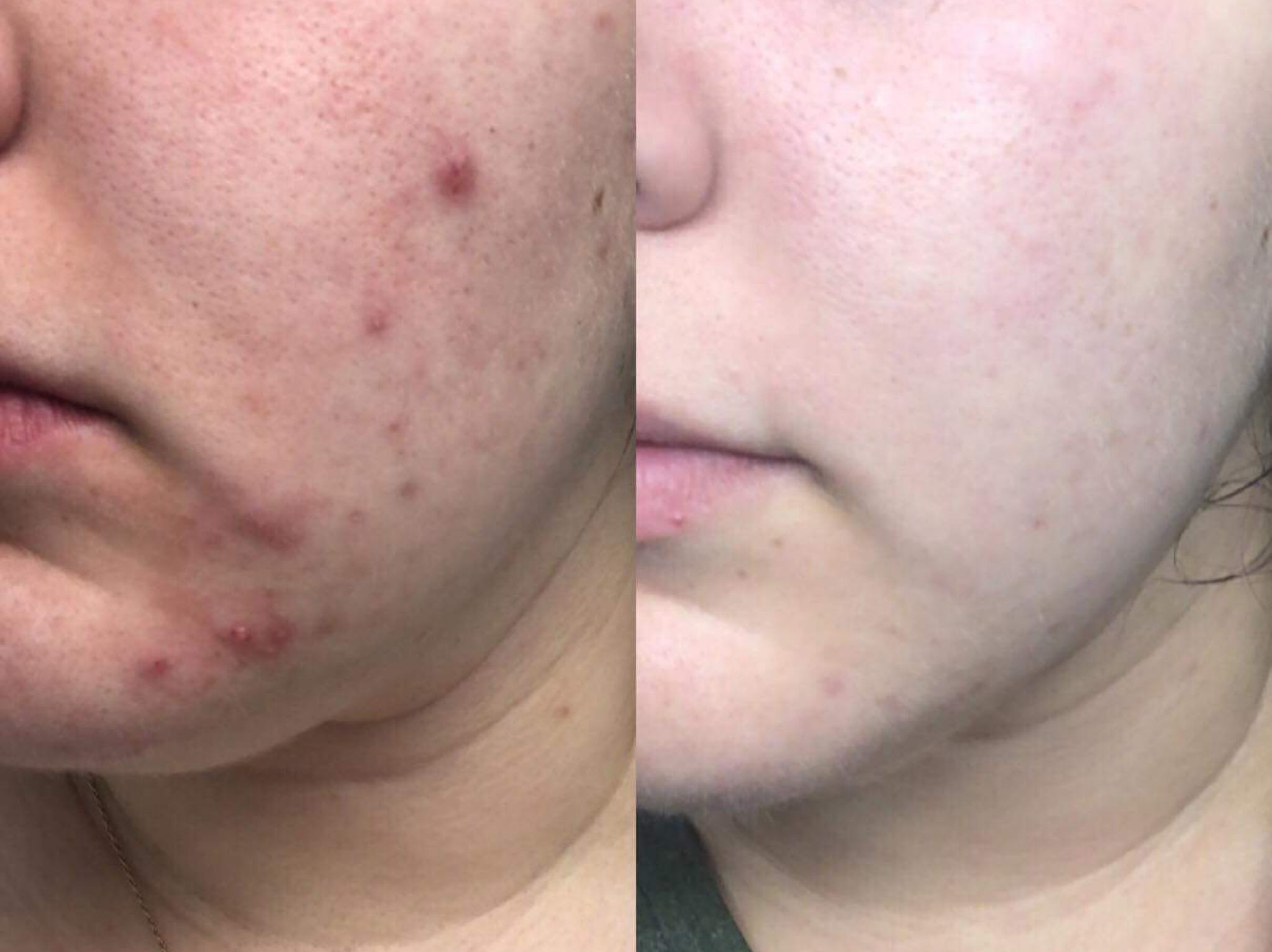Acne Before and After (2)