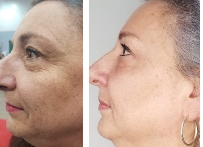 Botox Before and After Sparkle Moncton
