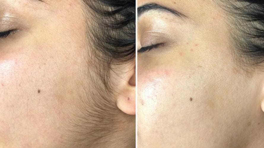 Dermaplaning Before After Moncton