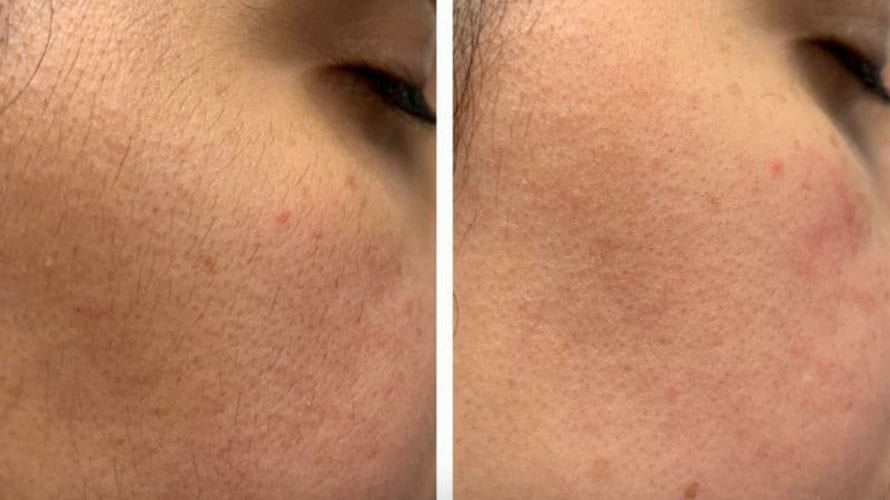 Dermaplaning Treatment Before After Moncton