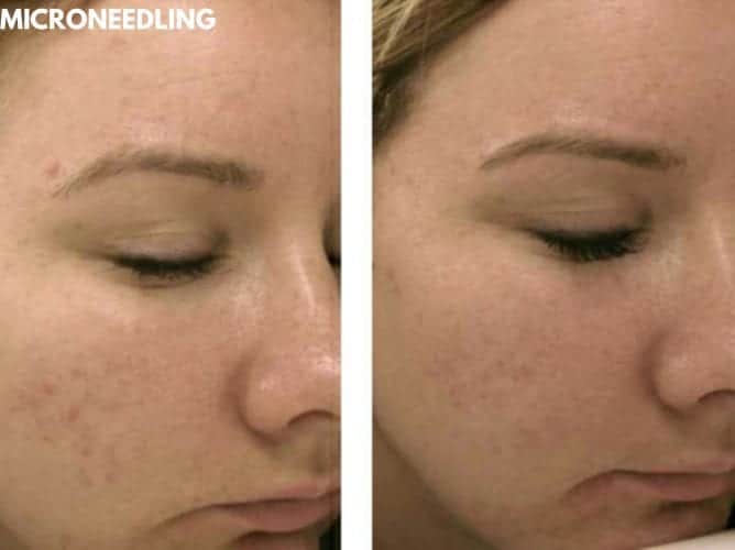 Microneedling Before After