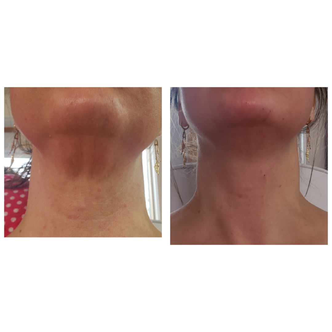 Neck Skin Tightening Before and After