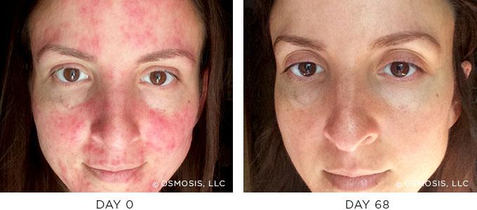 Osmosis Redness Before After
