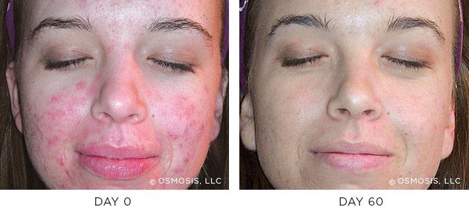 Osmosis Skincare Acne Before After