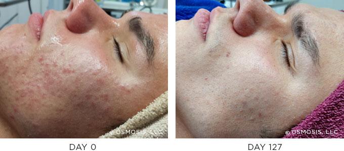 Osmosis Skincare Before After Canada