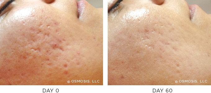 Osmosis Skincare Texture Before After