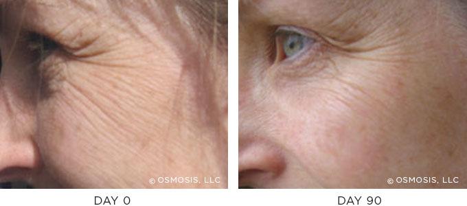 Osmosis Skincare Before After Eyes