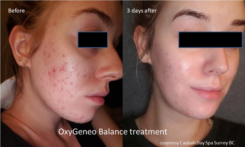 OxyGeneo Before After 8