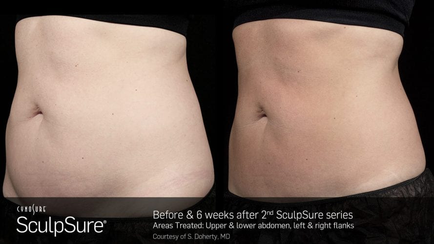 SculpSure Before After