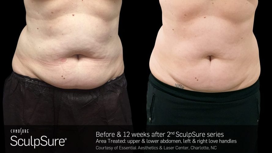 SculpSure Before After (2)