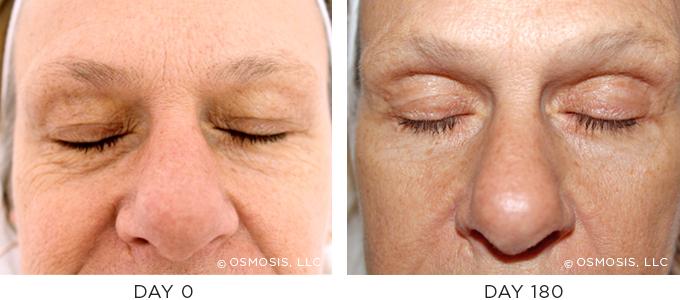 Osmosis Aging Before & After