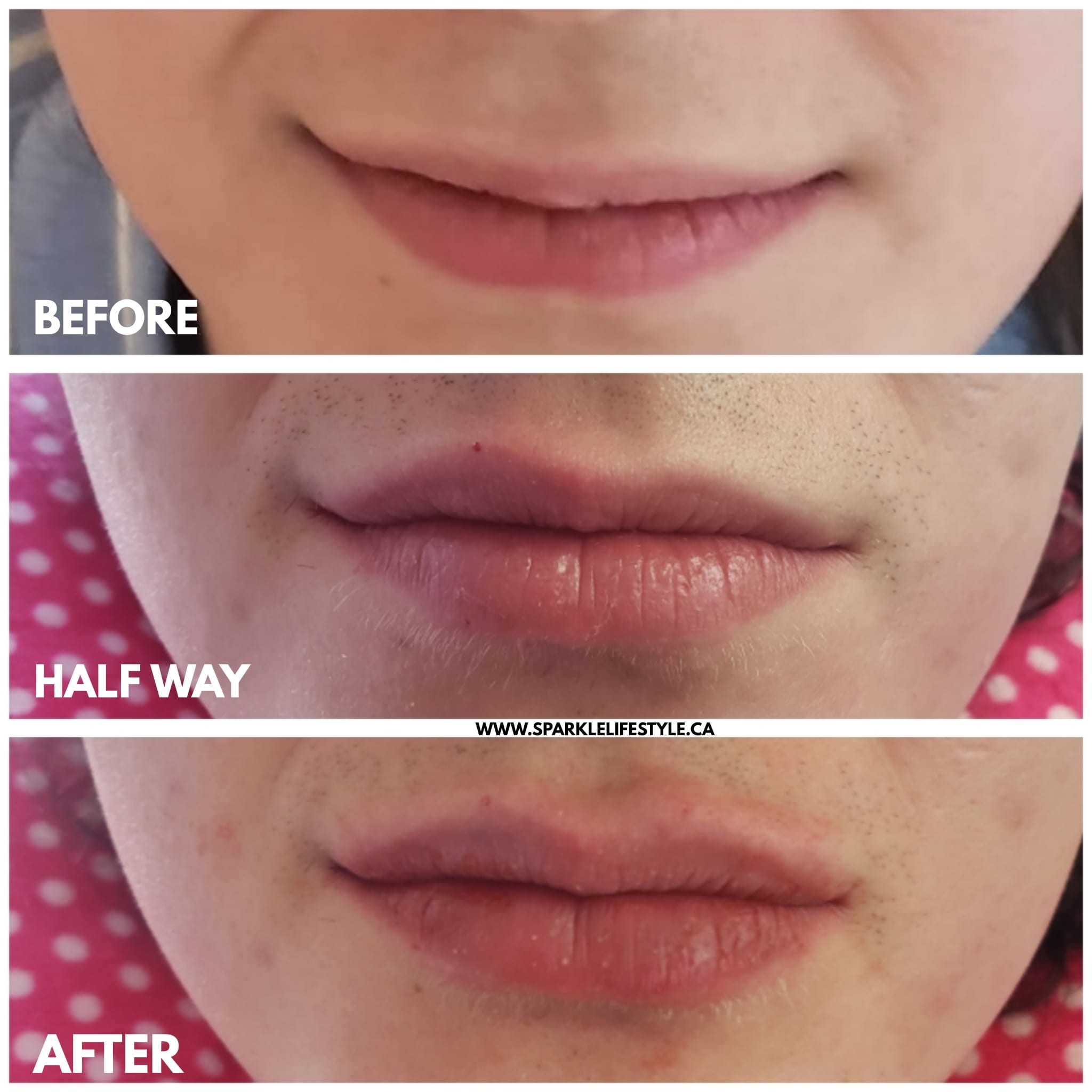 Lip Enhancement Before After