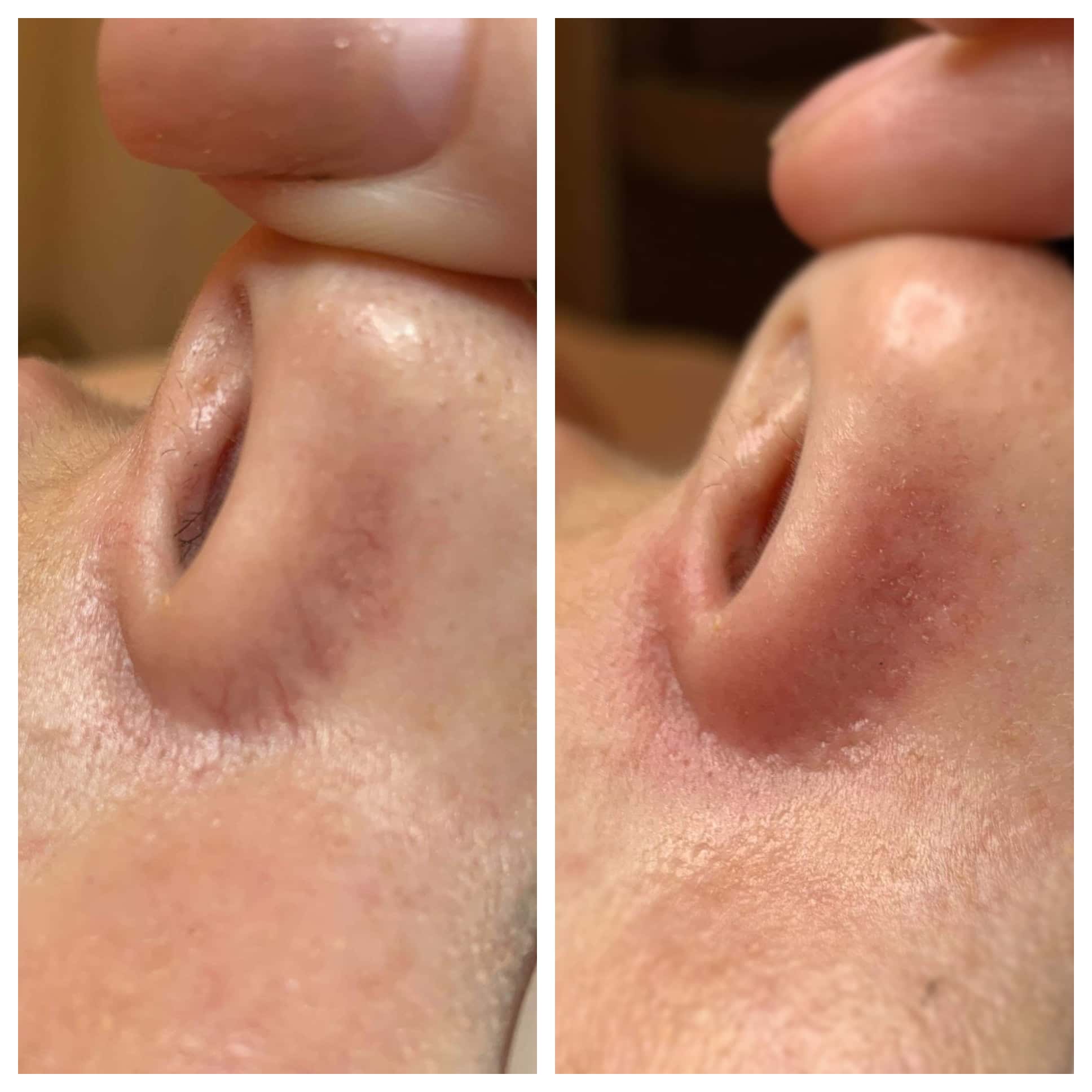 Nose Veins Before After