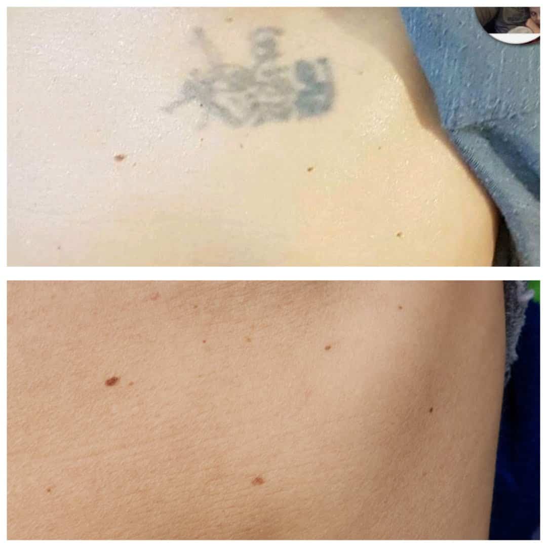 PicoWay Tattoo Removal Before After