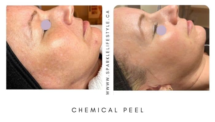 Chemical Peel Before After