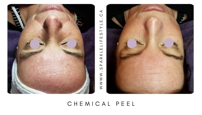 Chemical Peel Before After