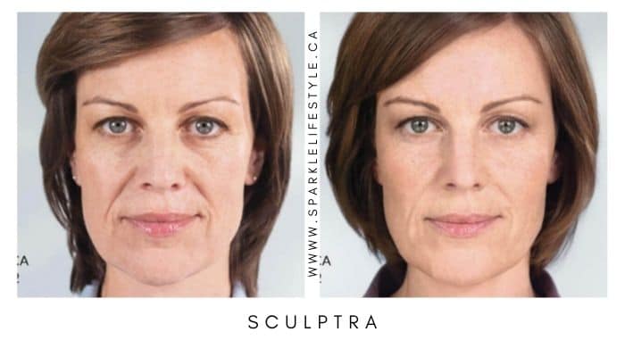 Sculptra Before After