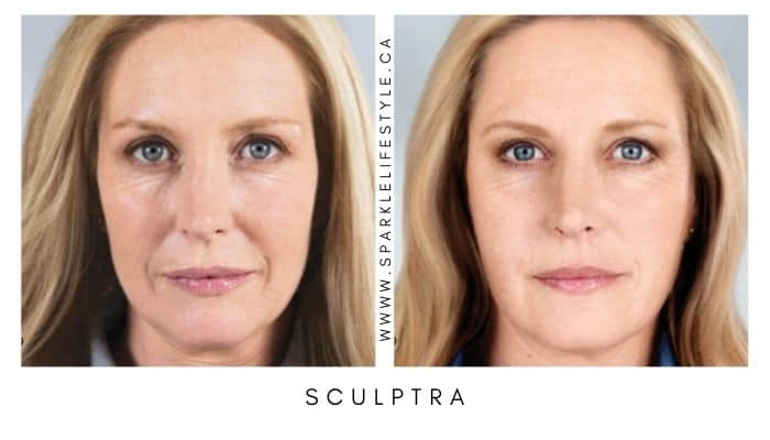 Sculptra Before After