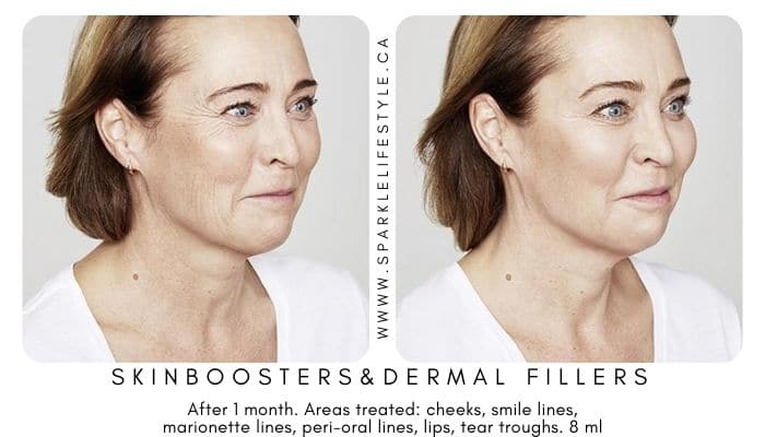 SkinBoosters Before After