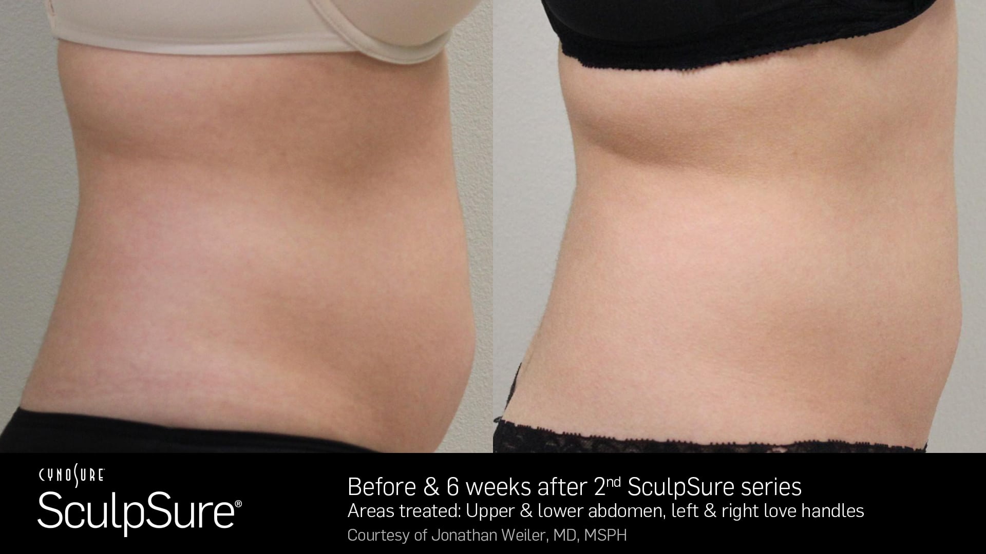 SculpSure Core Before and After Female 16 1