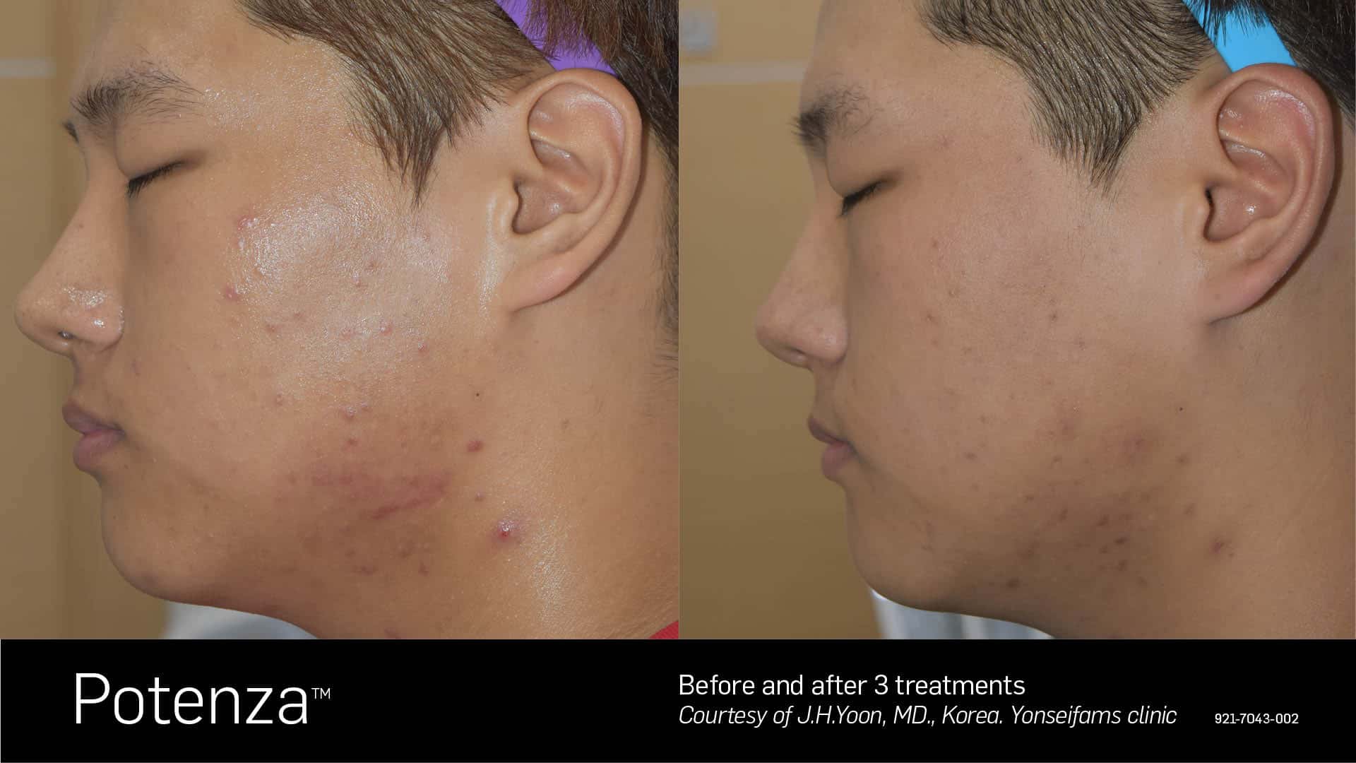 Potenza RF Microneedling Before After 4
