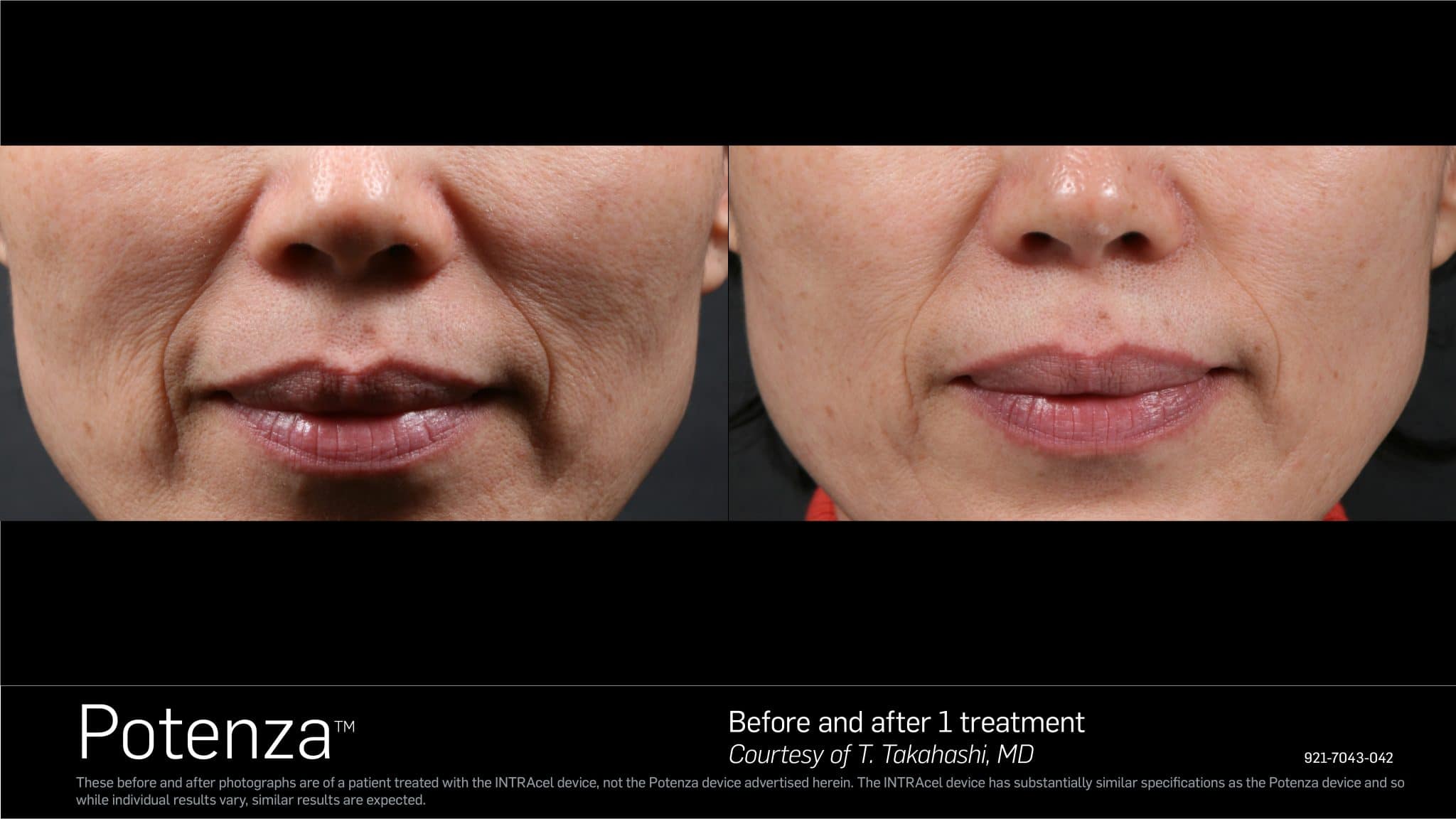 Potenza RF Microneedling Before After 6