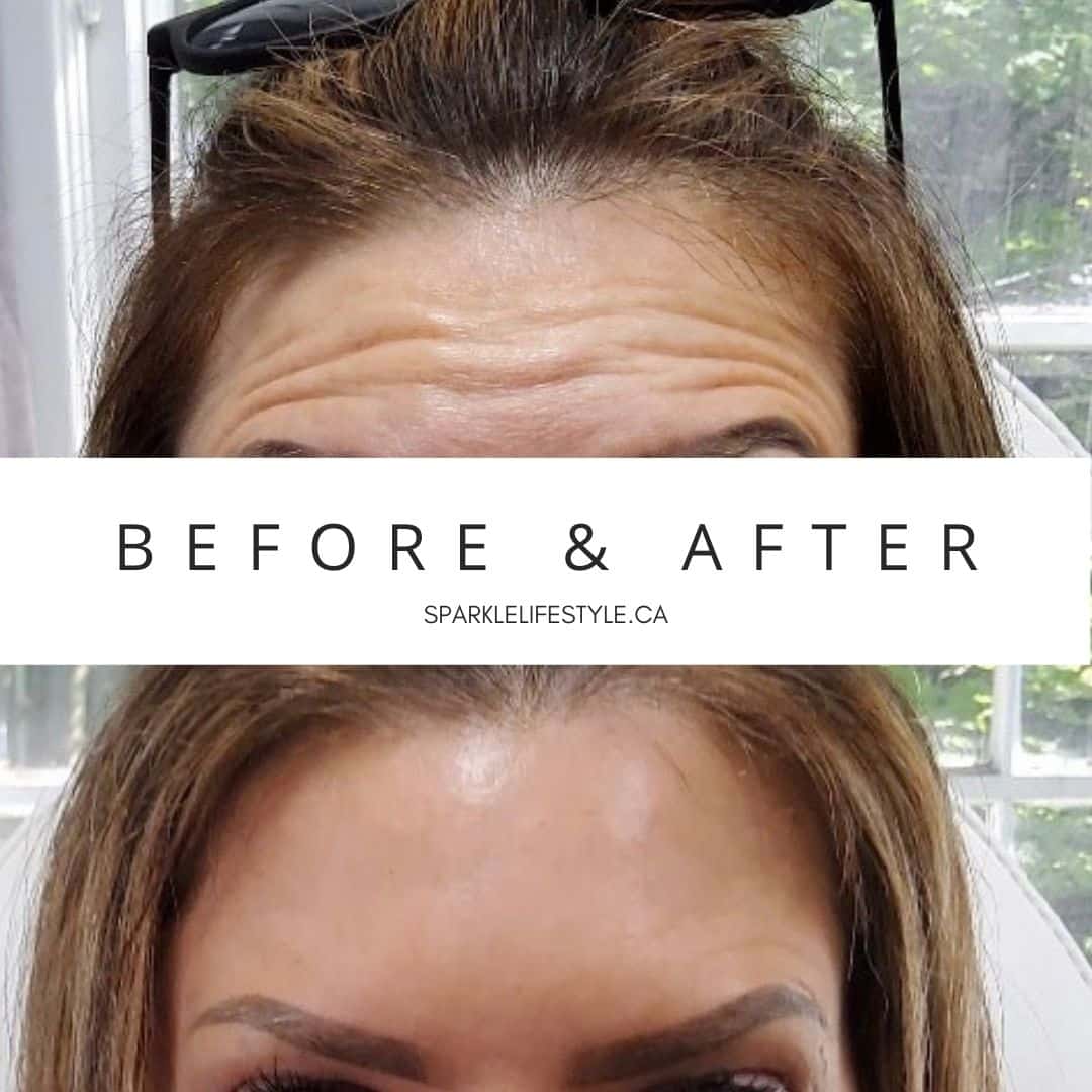 Before After Botox Moncton NB