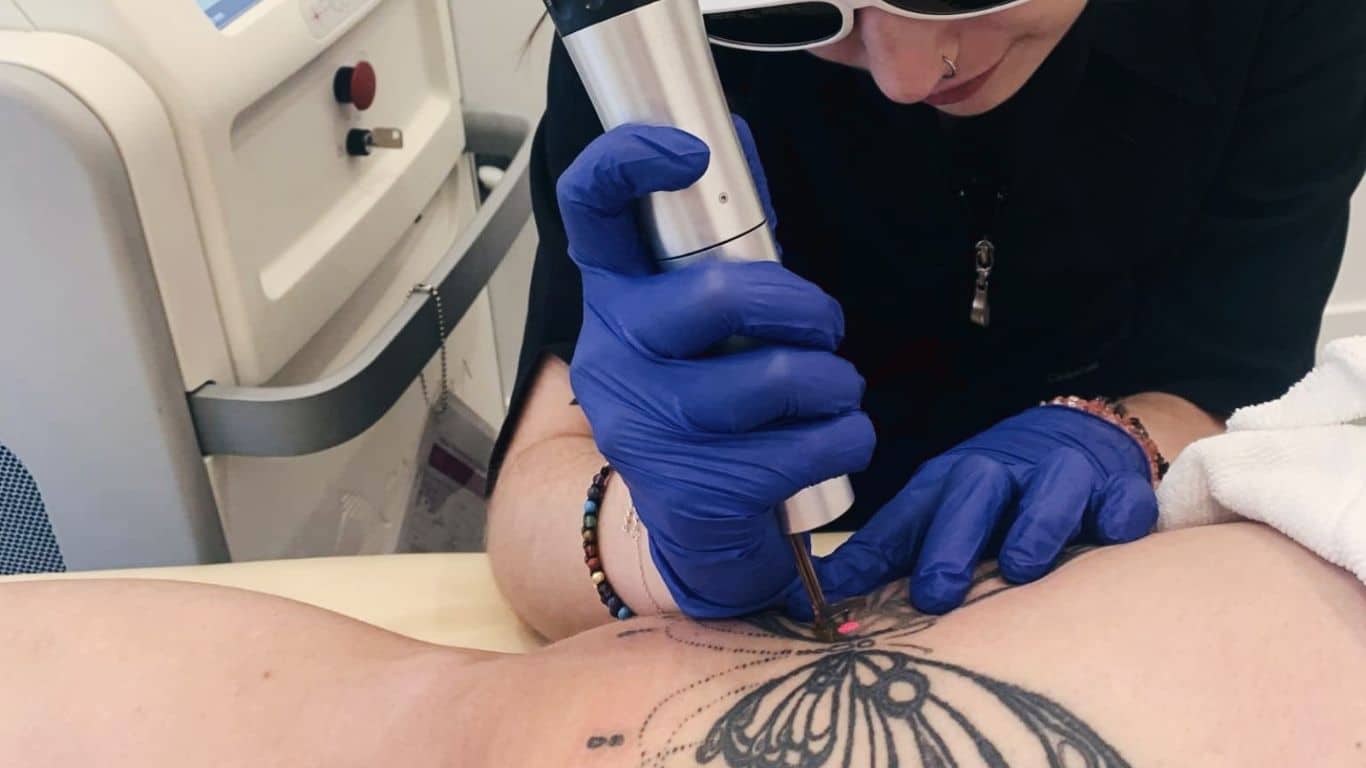 Best Tattoo Removal Laser PicoWay Moncton NB