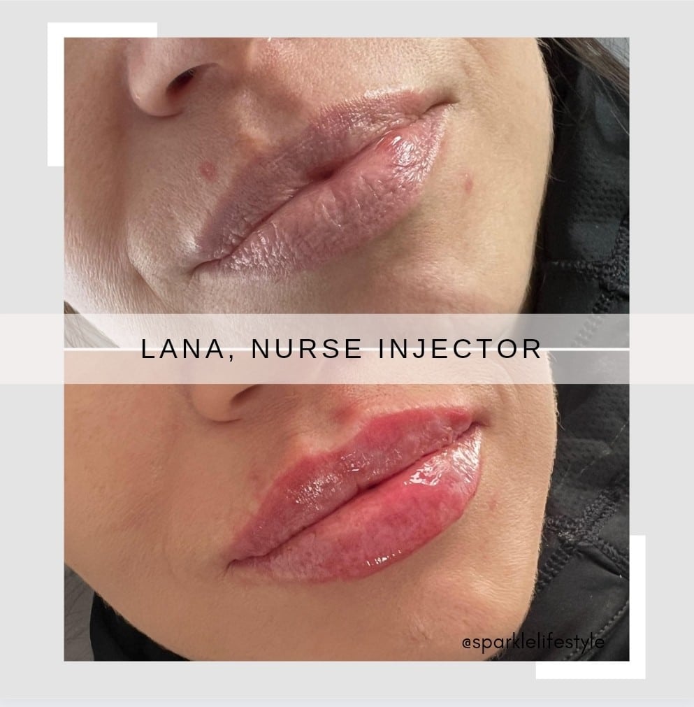 Lip Injection Before & After