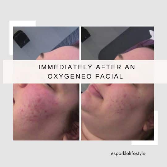 After OxyGeneo Before After