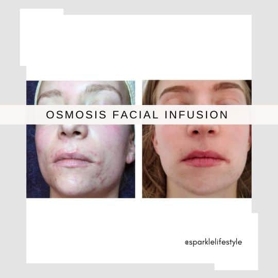 Osmosis Facial Infusion (2)