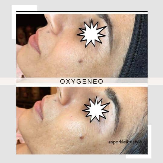 OxyGeneo Before After (2)