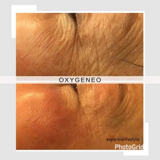OxyGeneo Before After