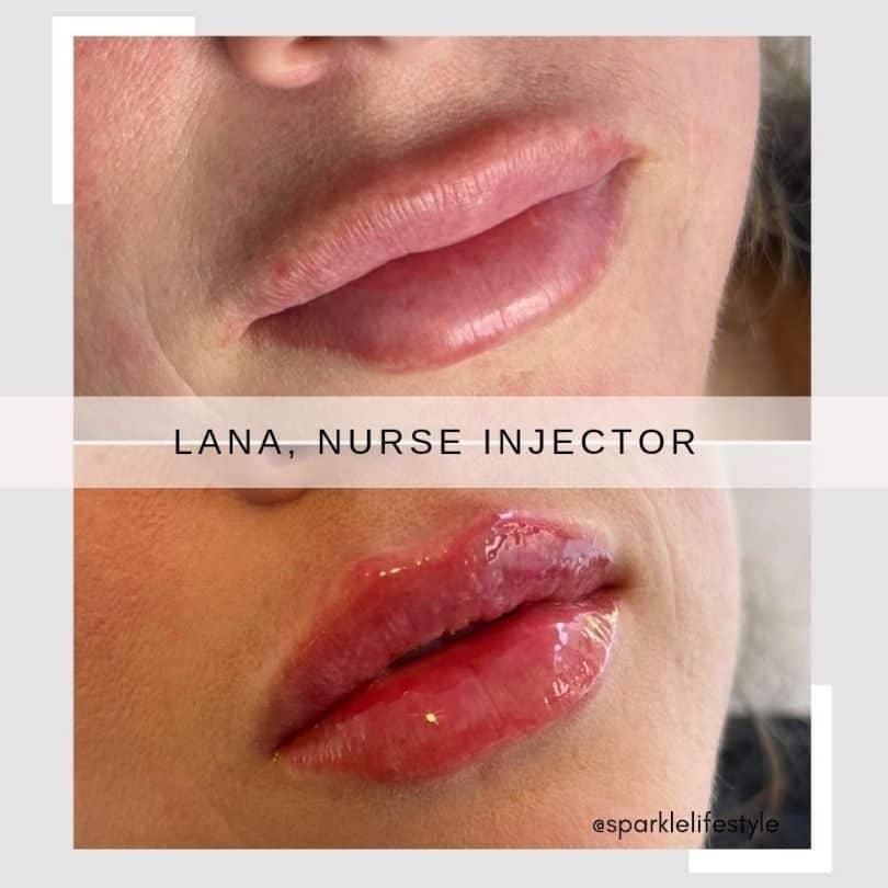 Before After Lips Lana