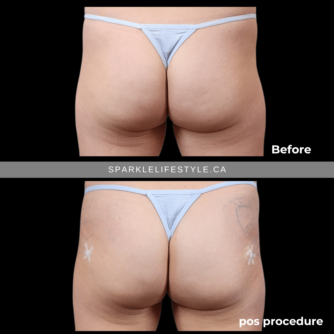 Brazilian Butt Lift Before and After