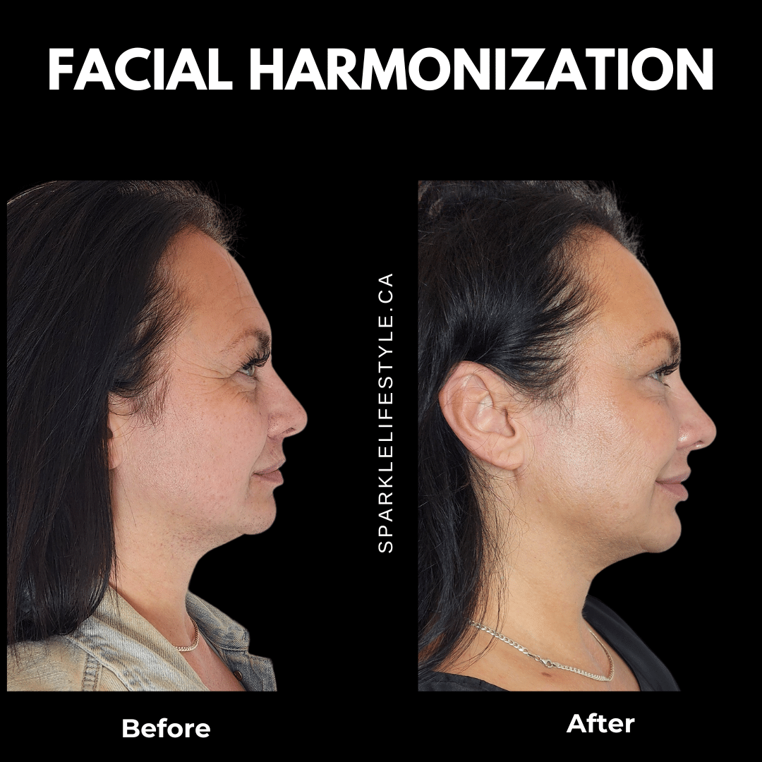 Facial Harmonization Before and After 1