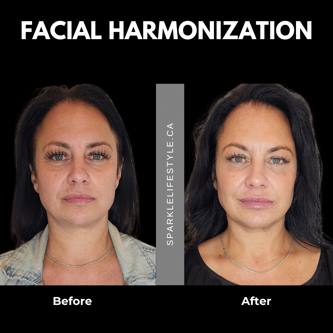 Facial Harmonization Before and After 2