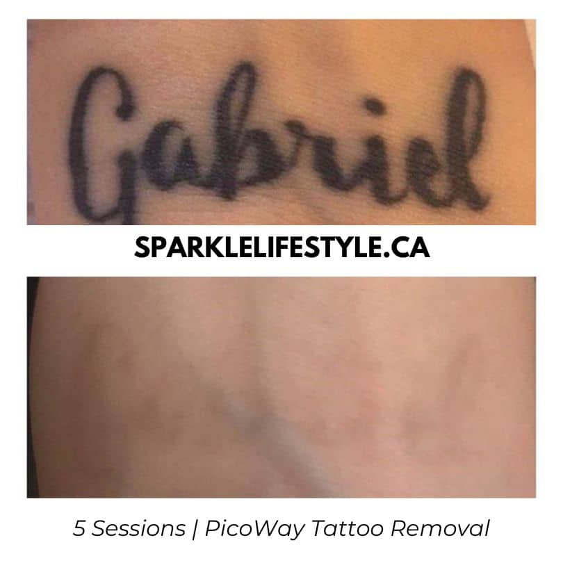 Before After Laser Tattoo Removal PicoWay