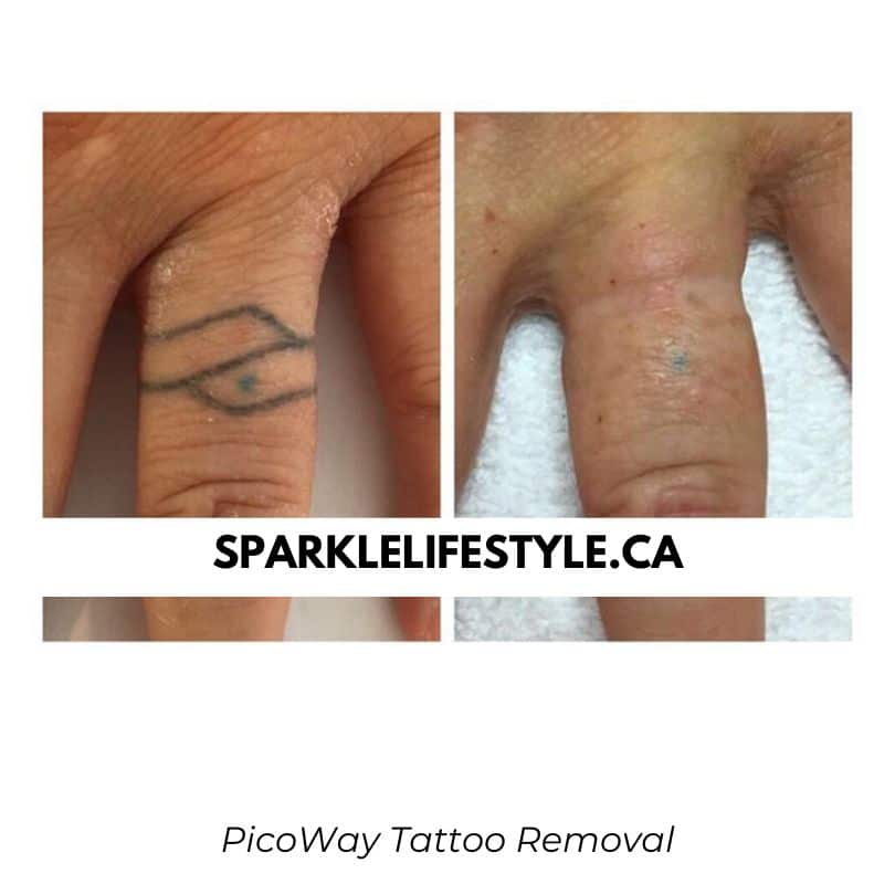 Before After Laser Tattoo Removal PicoWay