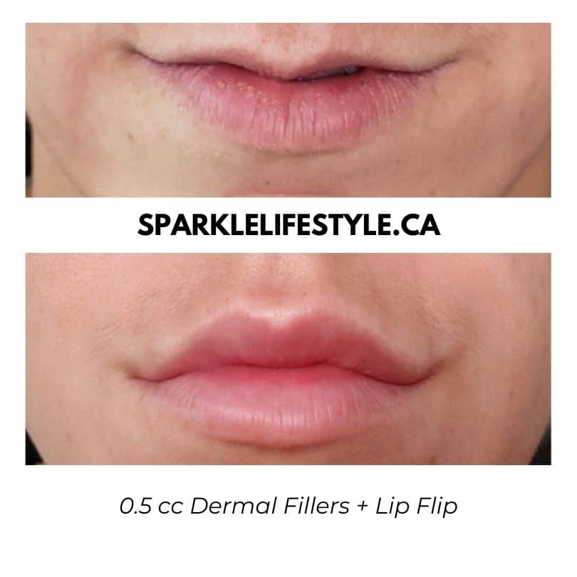 0.5 cc Dermal Fillers Lip Flip 1