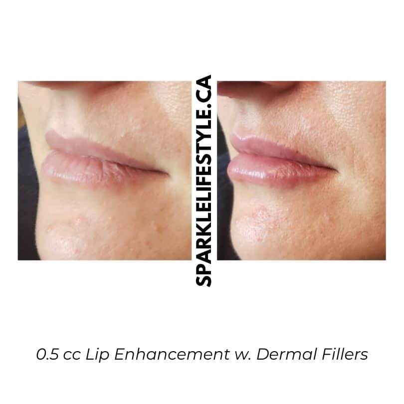 0.5 cc Lip Enhancement w. Dermal Fillers 1