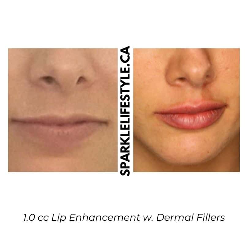 Lip Enhancement w Dermal Fillers