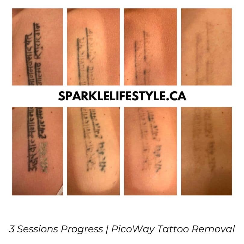 Before After Laser Tattoo Removal PicoWay 2 1