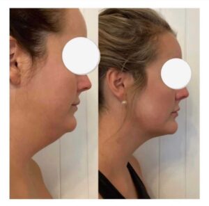 Belkyra before and after double chin treatment example at Sparkle Lifestyle and MediSpa