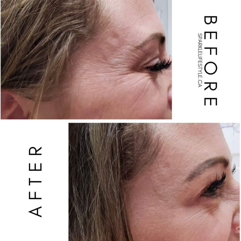 Botox-Before-After