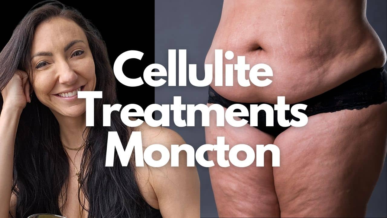 Cellulite Treatments Moncton
