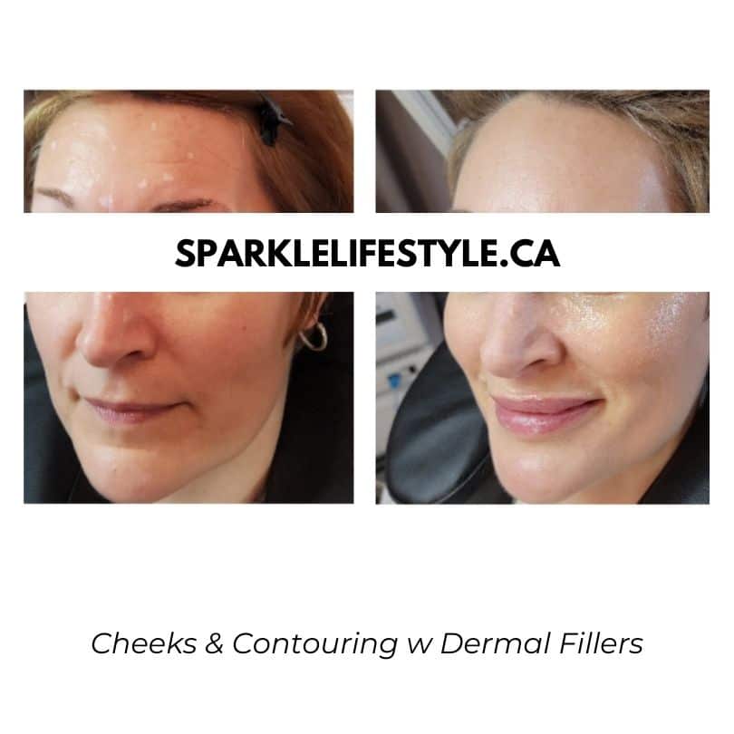 Cheeks-Contouring-w-Dermal-Fillers (1)