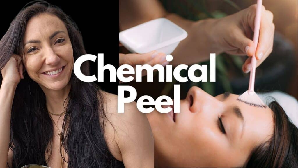 Chemical Peel Moncton NB