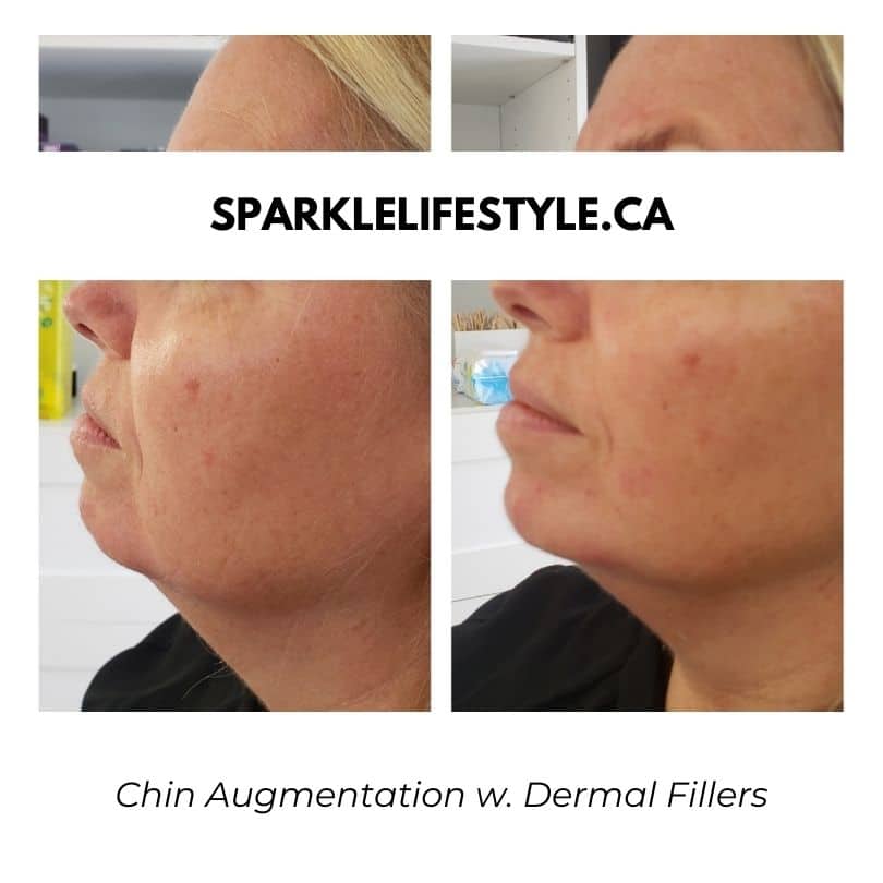 Chin-Augmentation-w.-Dermal-Fillers (1)